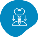 Dental Bone Grafting in Brisbane
