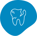 Cracked or Chipped Tooth