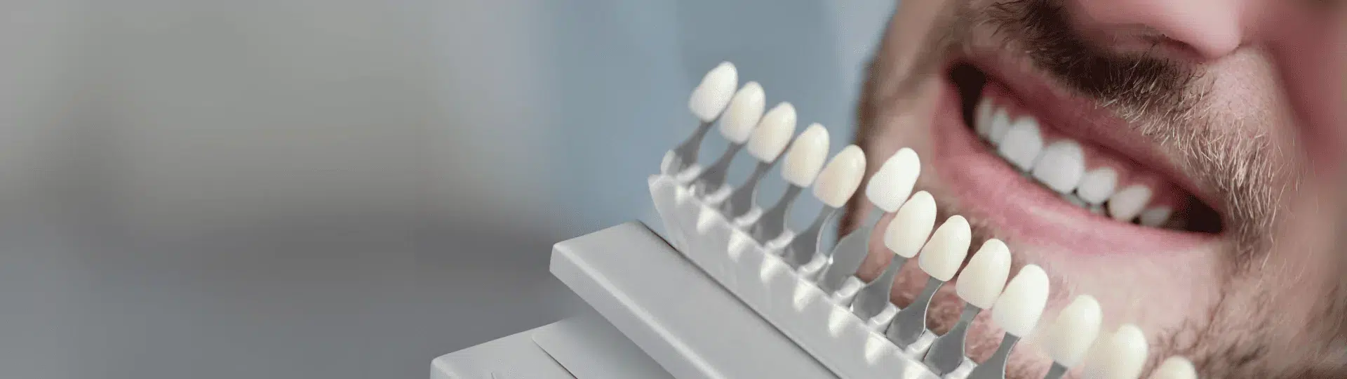 composite-veneers