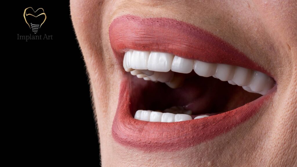 No prep veneers