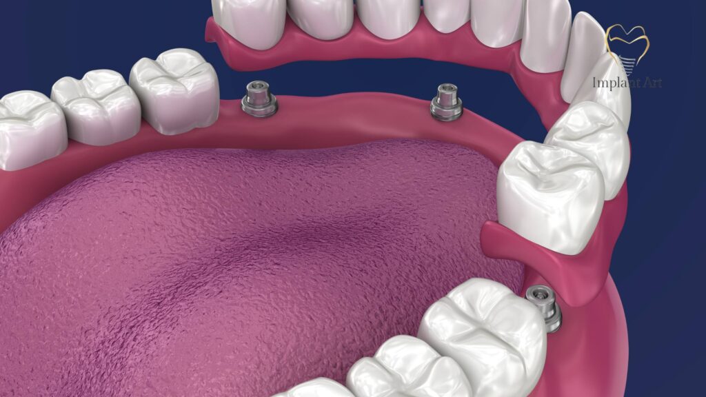 Dental Implant
