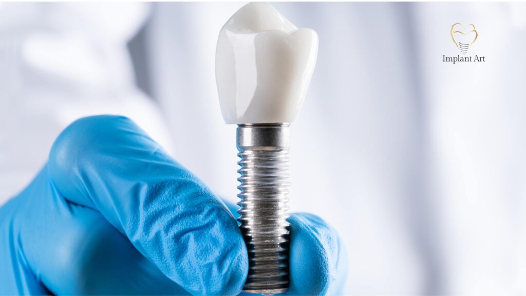 Dental Implant