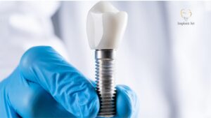 Dental Implant