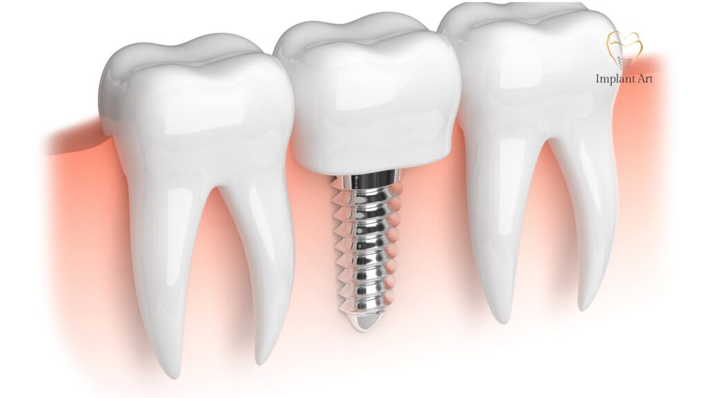 Dental Implants Brisbane
