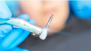 Best Dental Implants Brisbane