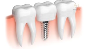 Dental Implants Brisbane