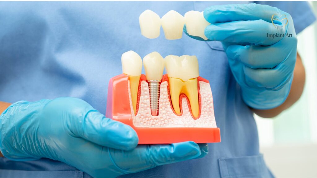 What Are Dental Implants