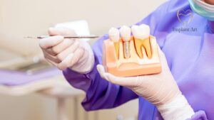Single Dental Implants