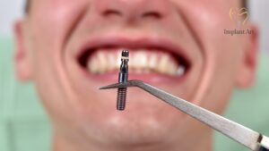 Single Dental Implant