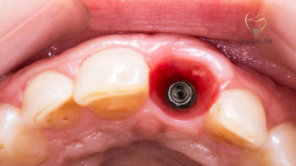 All on 4 dental implants brisbane
