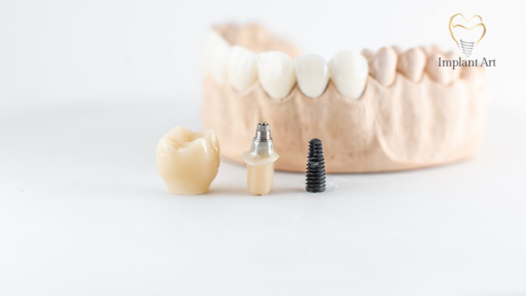 Single Dental Implant