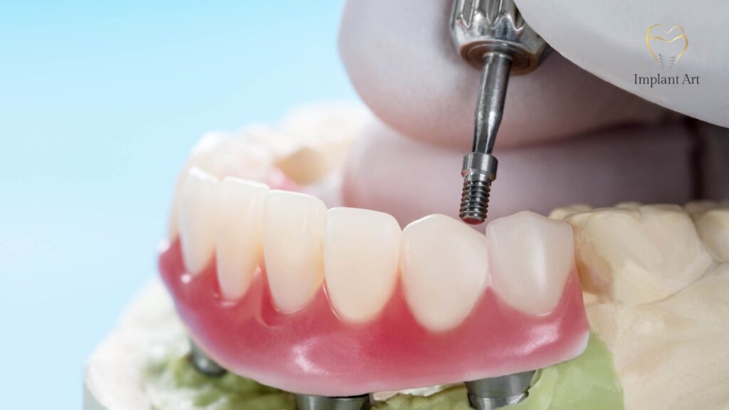 Implant-Supported Dentures