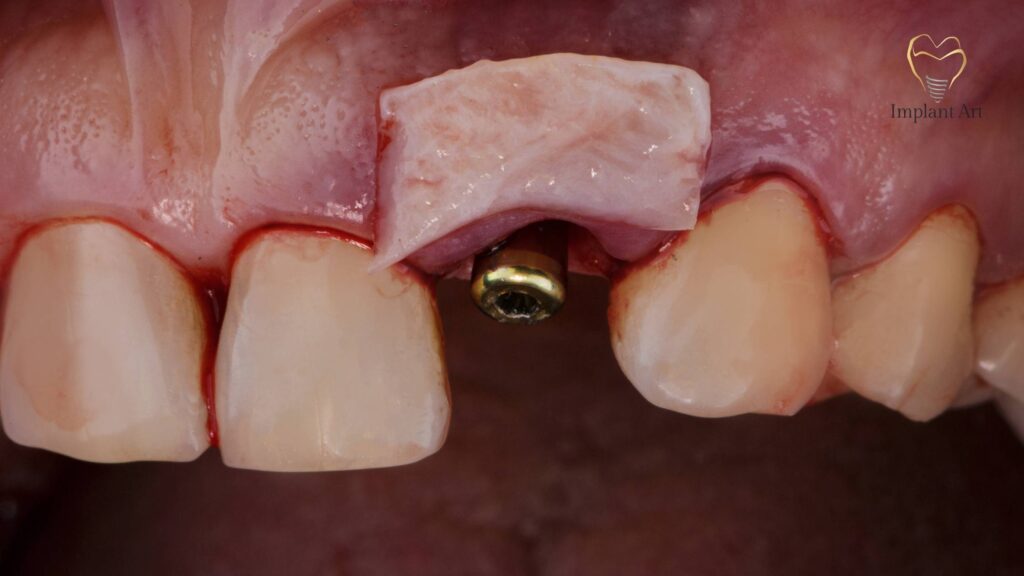 Dental Bone Graft