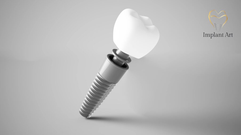 Dental Bone Graft