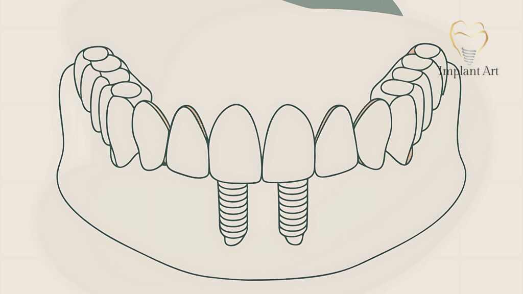 All-on-4 Dental Implants