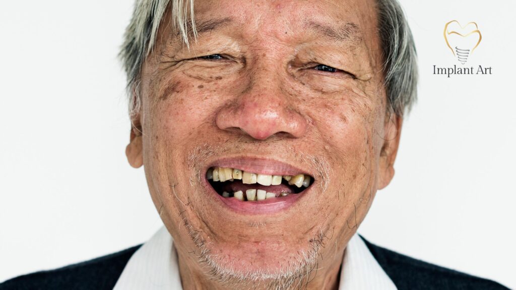 All-on-4 Dental Implants