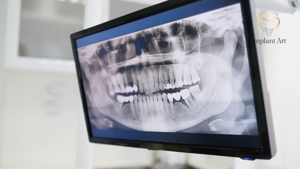 All on 4 dental implants brisbane